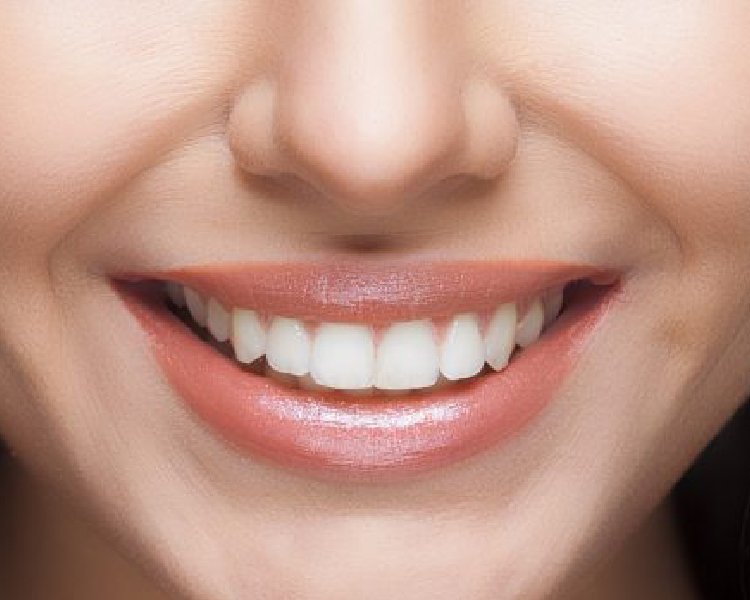 سمايل هوليوود في مركز اسنان سمايل دنتال دكتوره هبه العدل افضل أبتسامه هوليود