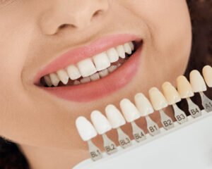 فينير الاسنان و اختيار لون العدسات الانسب للاسنان