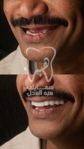 شكل قبل و بعد زراعة الفك كامل | عياده دكتورة هبة العدل